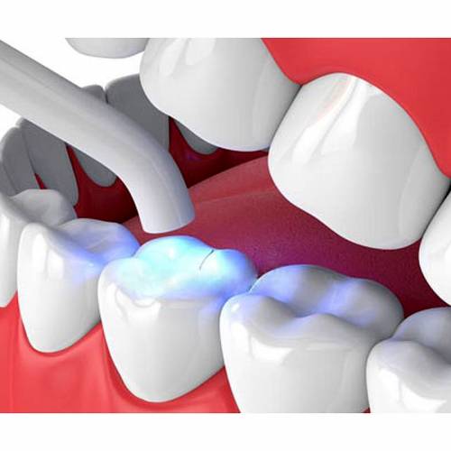 Cómo elegir la mejor resina para odontología según tus necesidades