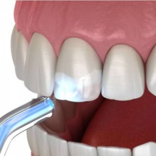 Cómo lograr la adhesión adecuada de las resinas para odontología